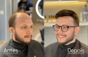 Resultado real de prótese capilar antes e depois do cliente 1