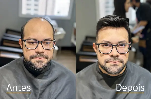 Resultado real de prótese capilar antes e depois do cliente 2
