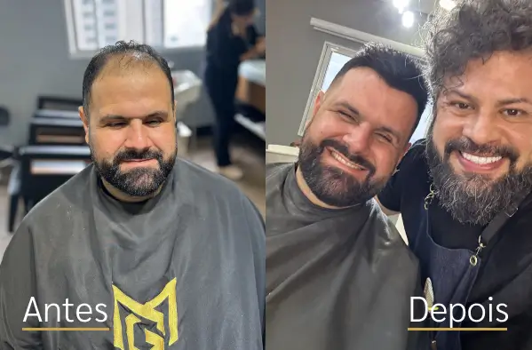 Resultado real de prótese capilar antes e depois do cliente 3