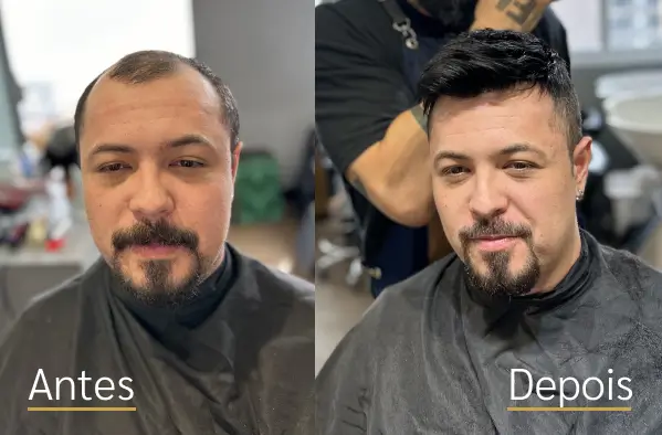 Resultado real de prótese capilar antes e depois do cliente 6