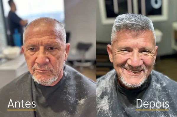 Resultado real de prótese capilar antes e depois do cliente 7