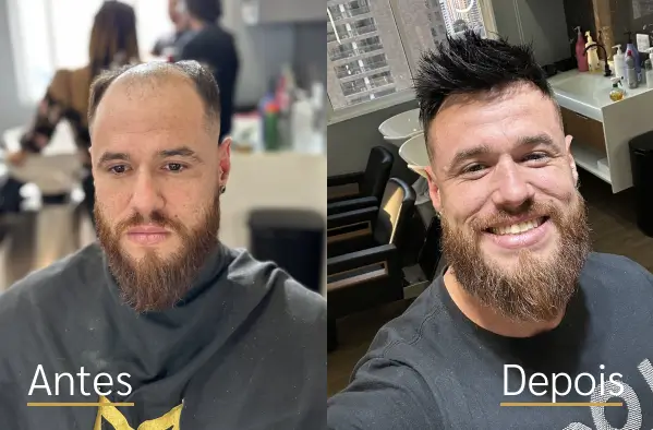 Resultado real de prótese capilar antes e depois do cliente 8